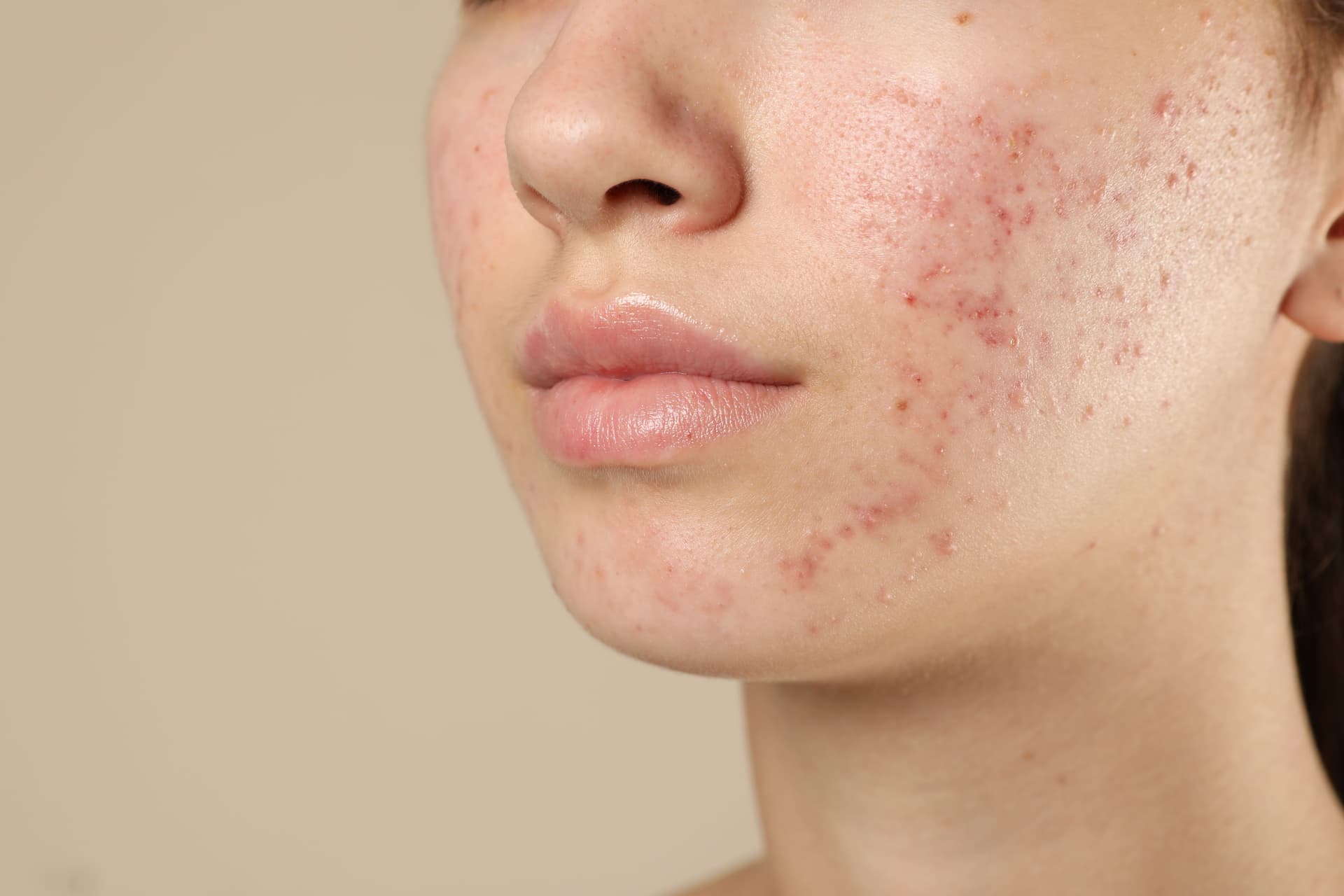 Tratamento Acne