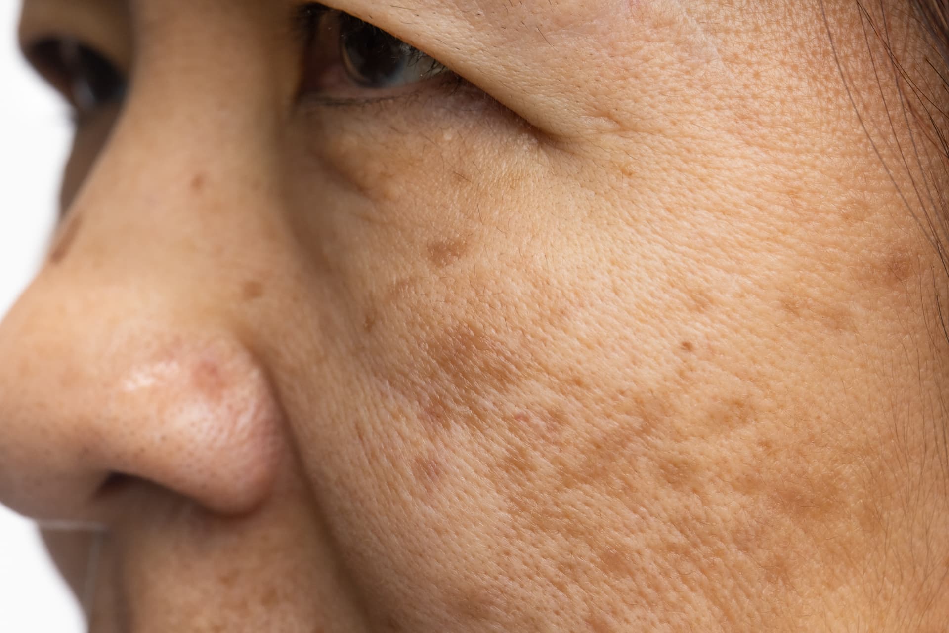 Tratamento Melasma